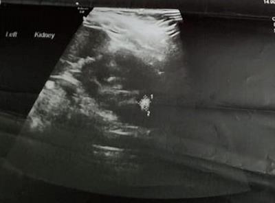 Antenatal urolithiasis: A case report
